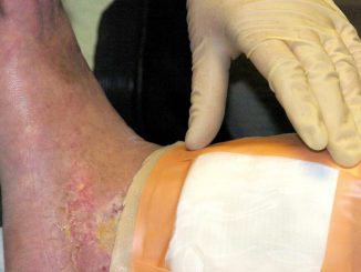 Second carcass-eating fly species cleared by FDA for maggot wound therapy