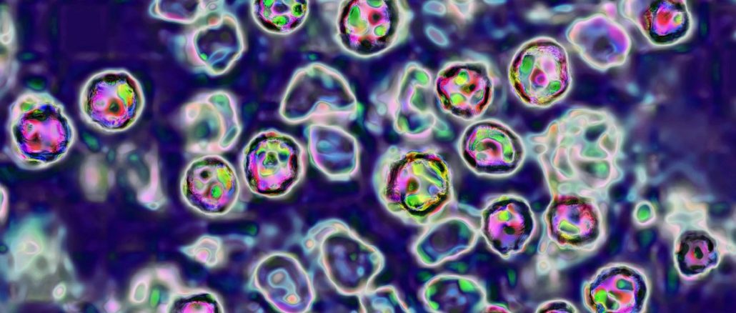 Unvaccinated Pennsylvania woman died of measles complications, coroner says