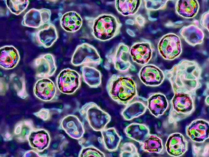 Unvaccinated Pennsylvania woman died of measles complications, coroner says