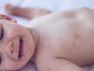 Crying baby girl with measles